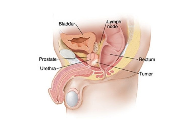 Carcinoma Prostate