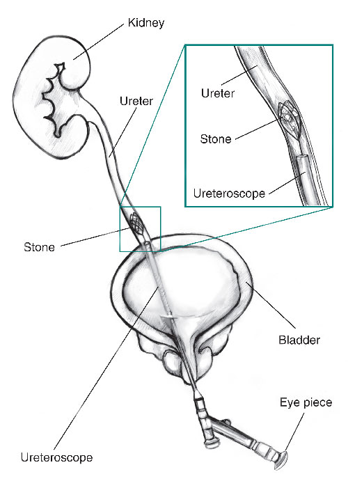 ureteroscopy1.jpg