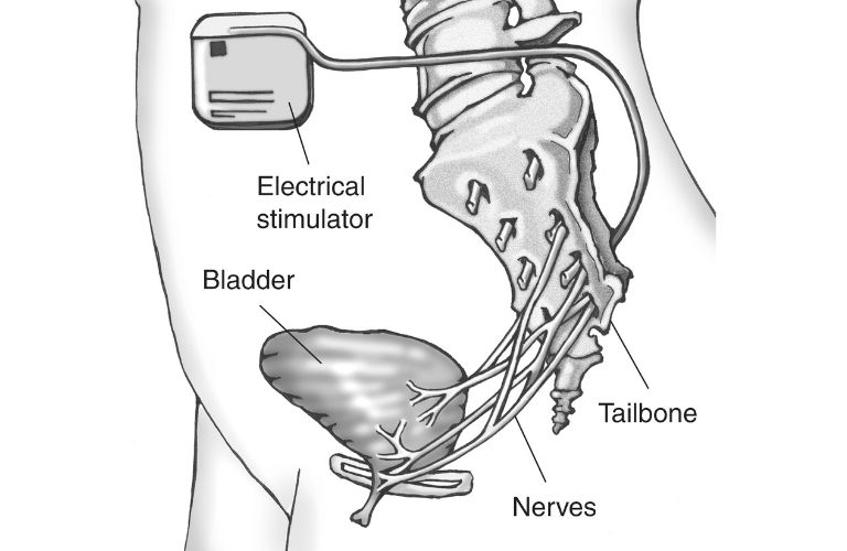 Percutaneous Tibial Nerve Stimulation (PTNS)
