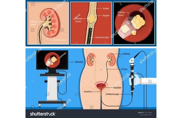 ureteroscopy